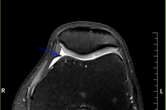 Le verdict: syndrome de plica